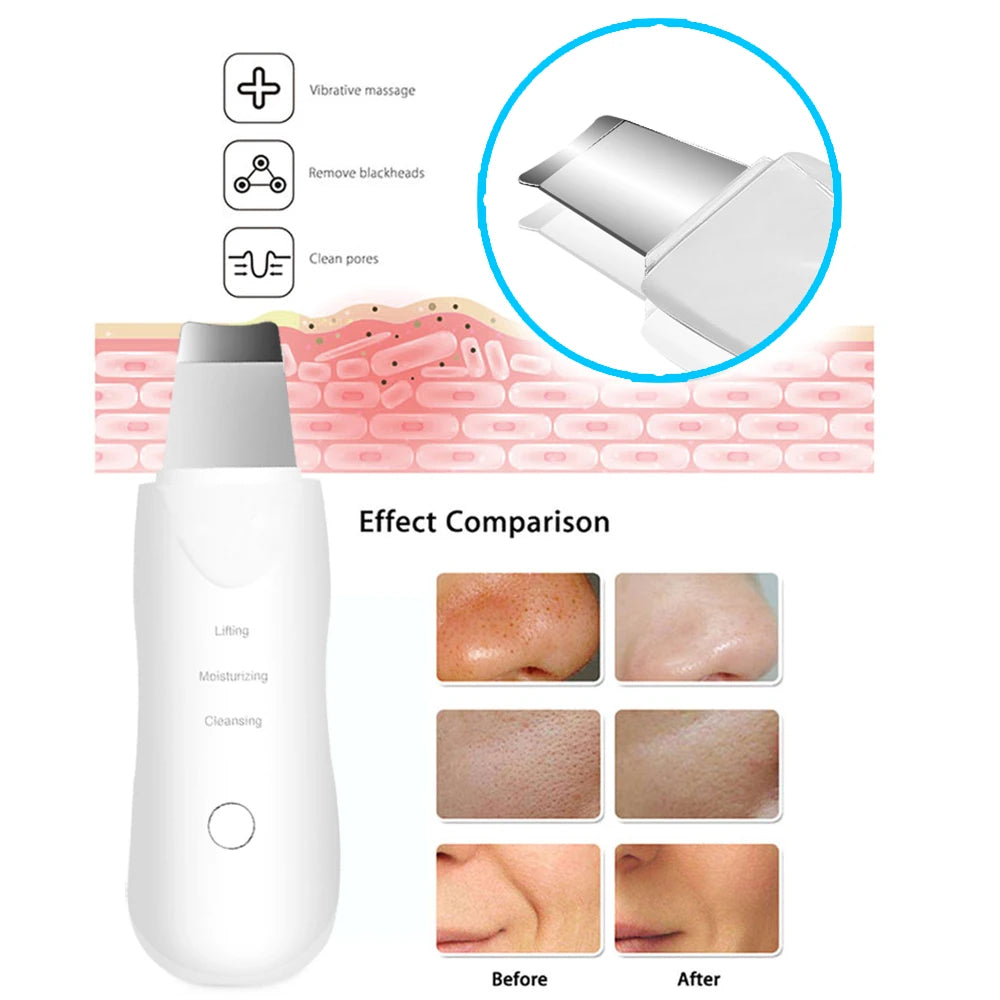 Ultrasonic Skin Scrubber Vibration Face Blackhead Remover